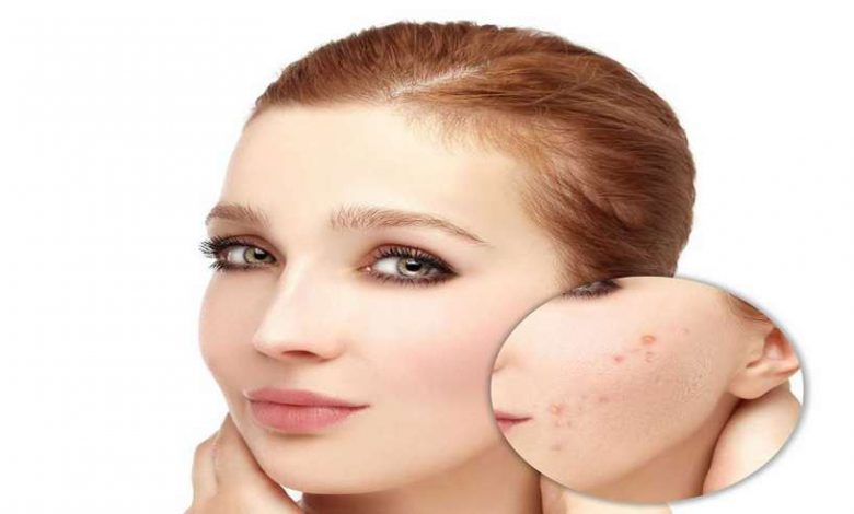 جوش پس از اپیلاسیون | درمان جوش پس از اپیلاسیون