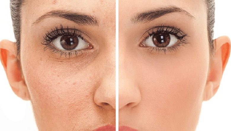 سلولیت سلولیت | کراتوز پیلاریس | منافذ پوست