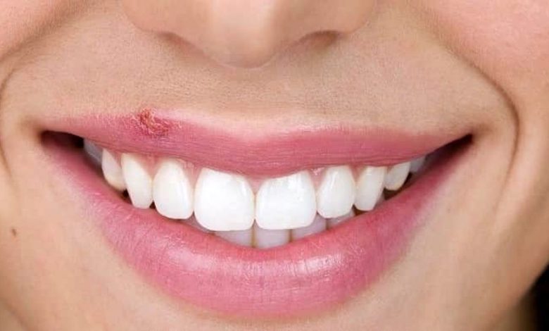 تاول ویروسی | تبخال | علل بروز تبخال