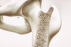 ۲۰ اکتبر | Osteoporosis | استئوپروز