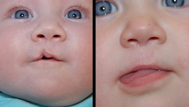 شکاف دهان | شکاف کام