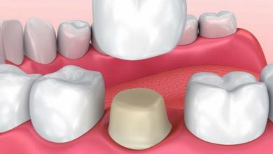 انواع روکش دندان