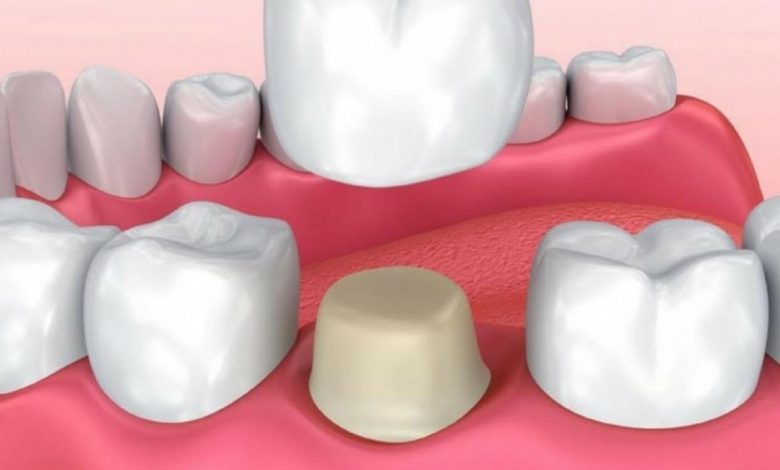 انواع روکش دندان