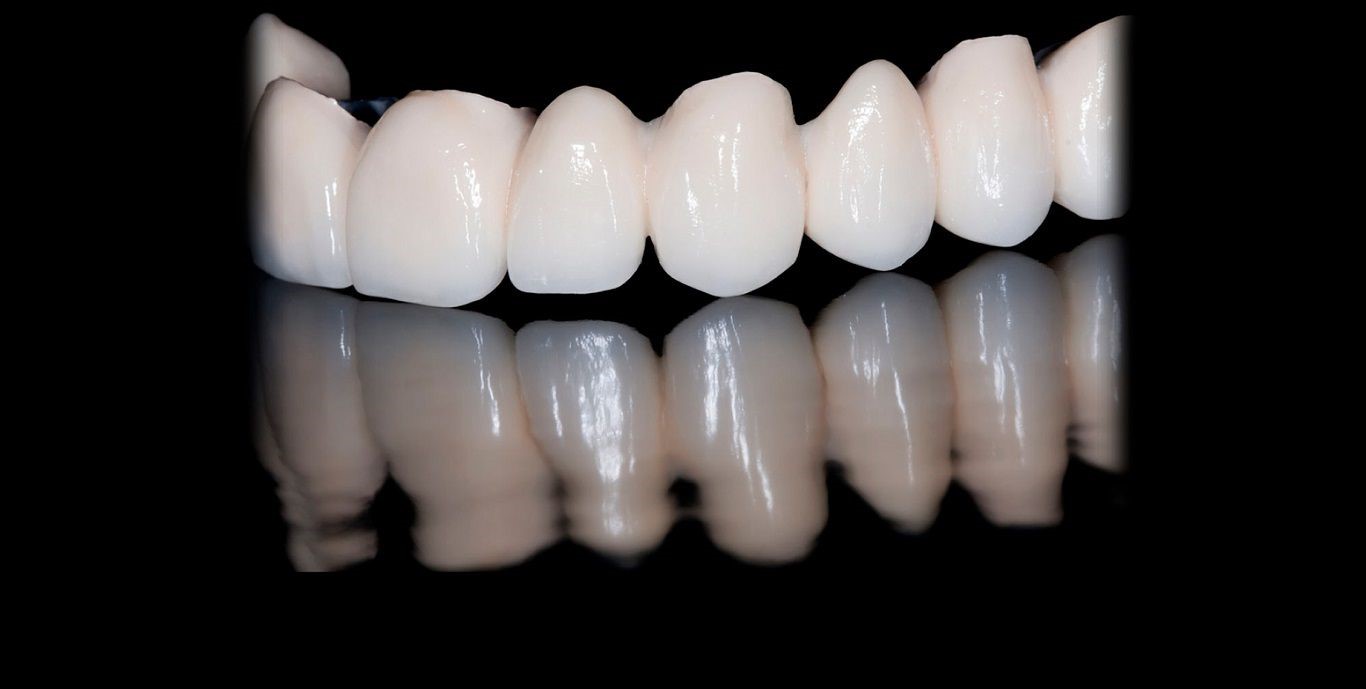 روکش دندان | روکش دندان سرامیک | روکش دندان فلزی