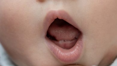 بهداشت دهان کودکان | علائم آفت دهان کودک چیست