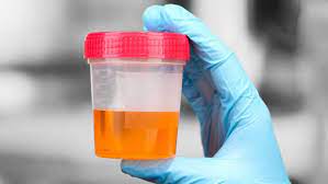 اورولوژیست | عفونت مجاری ادراری | وجود خون در ادرار