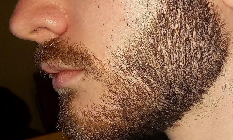 انواع روش های کاشت ریش | ریپورتاژ | کاشت ریش با روش SUT