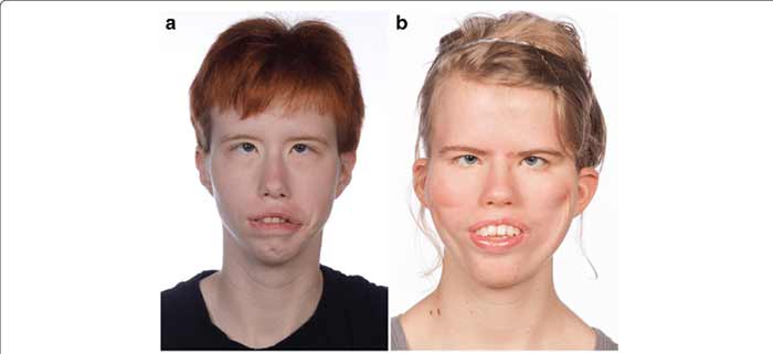 سندرم موبیوس