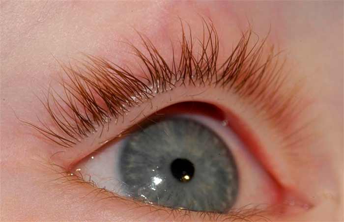 بیماری چشم پروانه‌ای