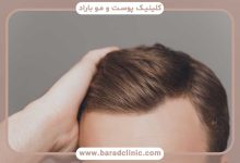 خط رویش طبیعی مو