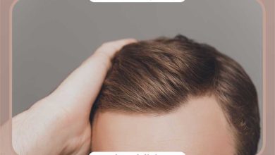 خط رویش طبیعی مو