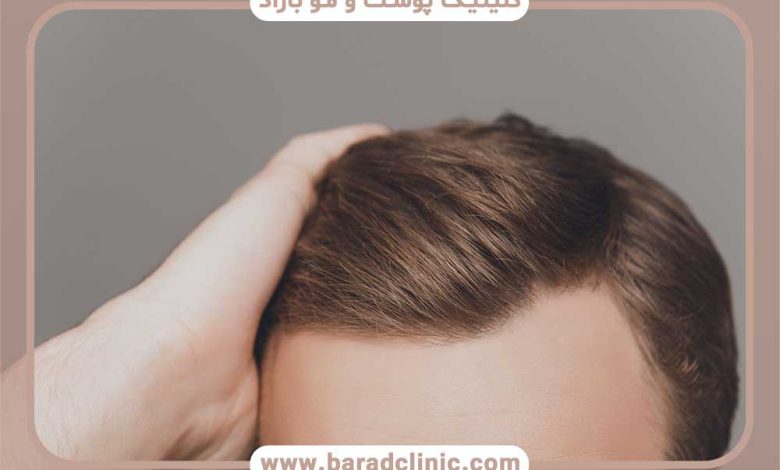 خط رویش طبیعی مو